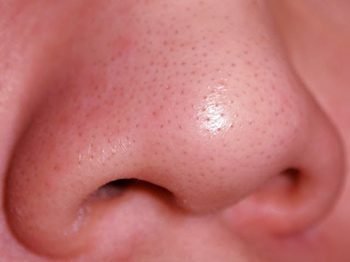 home-remedies-for-blackheads