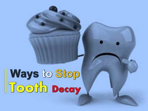 Tooth Decay