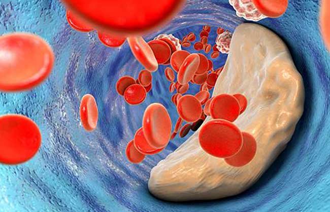 Ways to Lower Bad Cholesterol